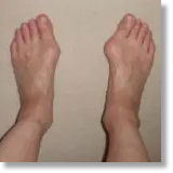 Sheeza - Bunions